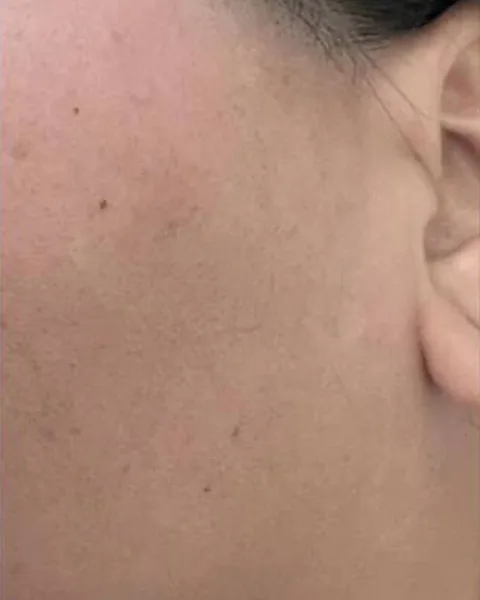 Smooth skin after facial laser hair removal at Pari Med Spa