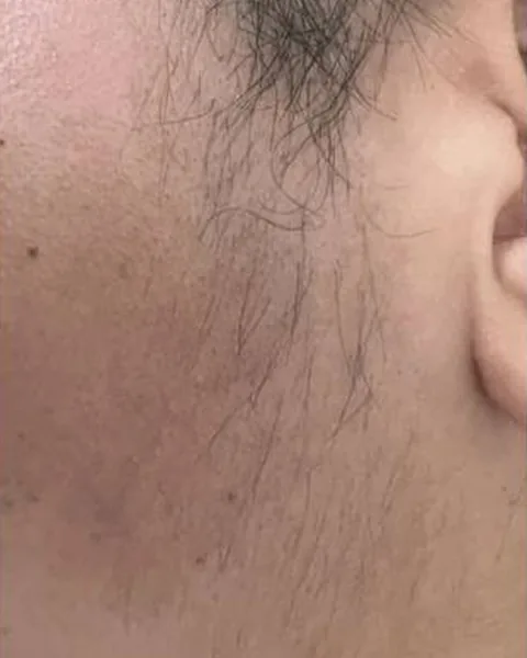Facial hair before laser hair removal