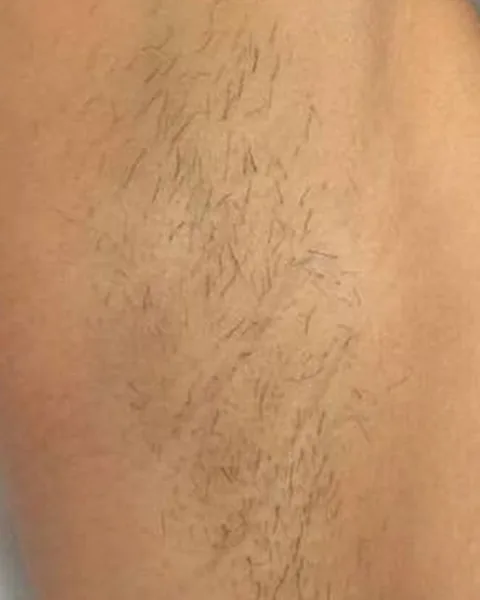 Underarm hair before laser hair removal