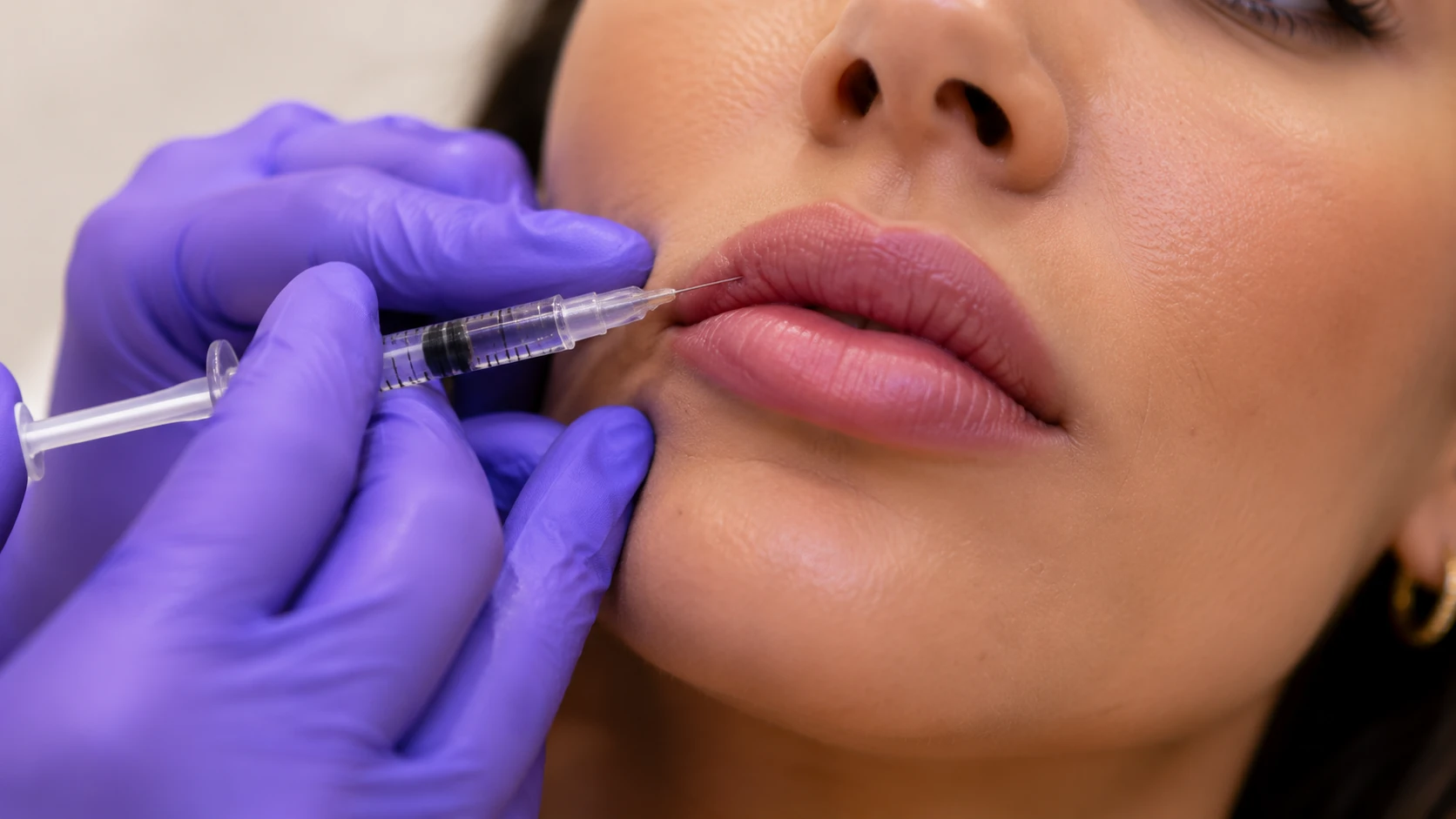 Botox lip flip treatment