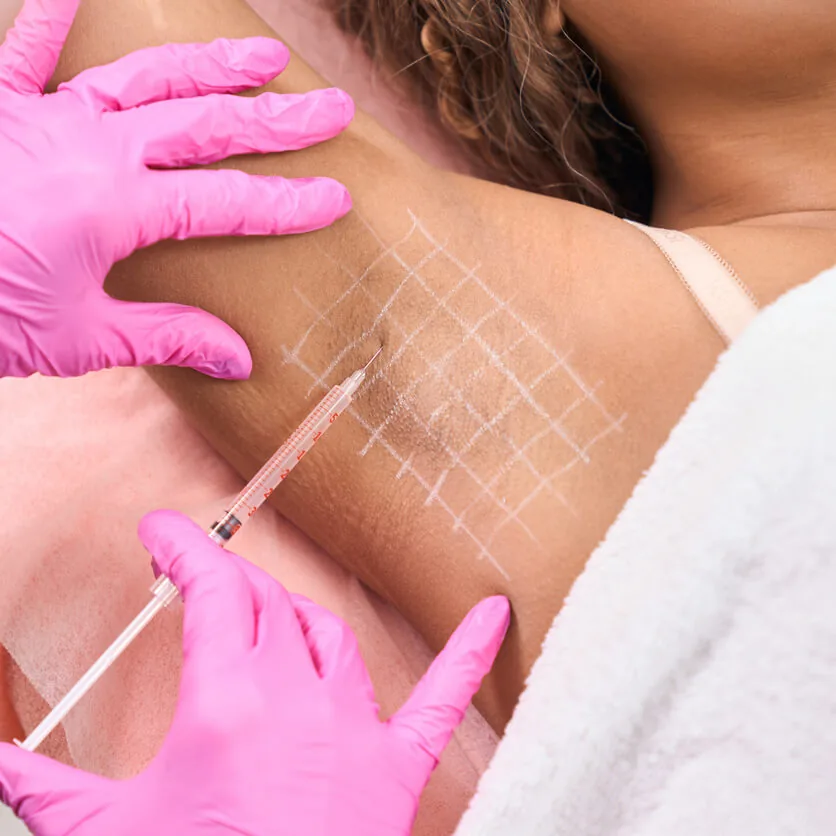 Botox injections in the underarm for excessive sweating