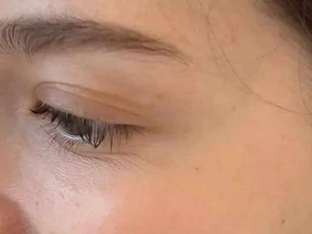 Smoother crow's feet after Botox at Pari Med Spa