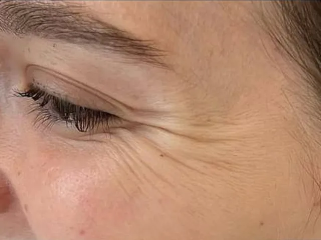 Crow&rsquo;s feet before Botox