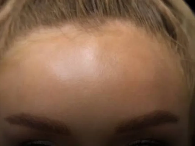 Smoother frown lines (11s) after Botox at Pari Med Spa