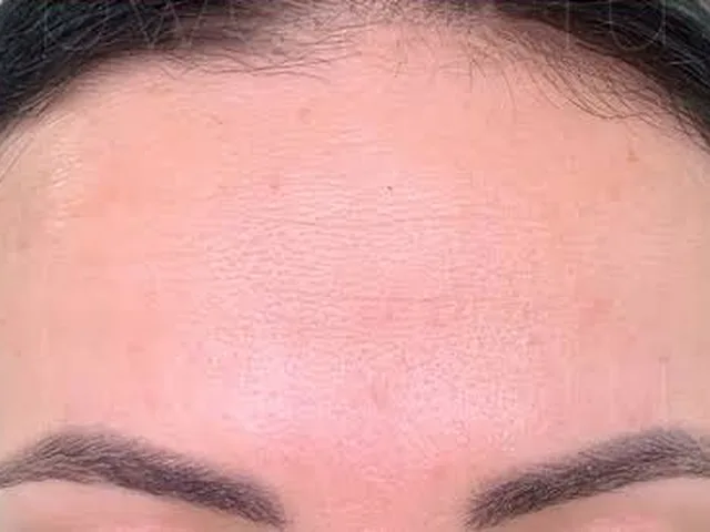 Smoother forehead lines after Botox at Pari Med Spa