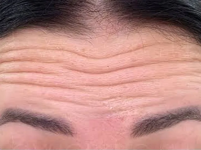 Forehead lines before Botox