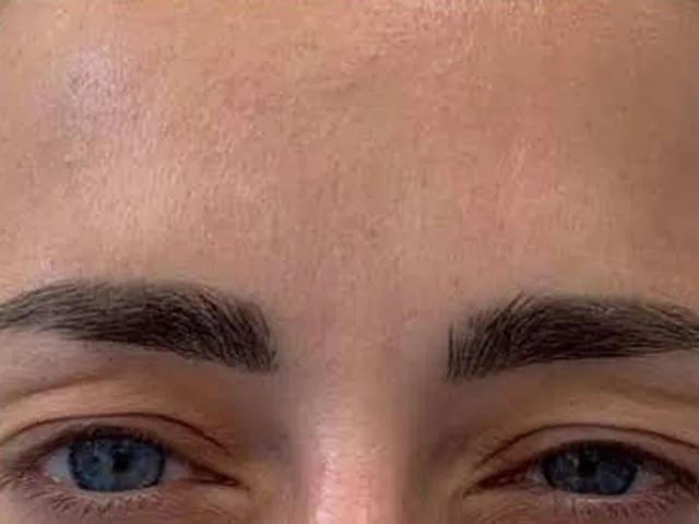 Smoother frown lines (11s) after Botox at Pari Med Spa