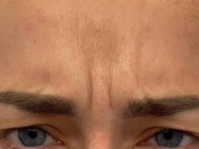 Frown lines (&ldquo;11s&rdquo;) before Botox