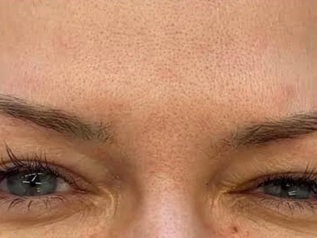 Smoother frown lines (11s) after Botox at Pari Med Spa