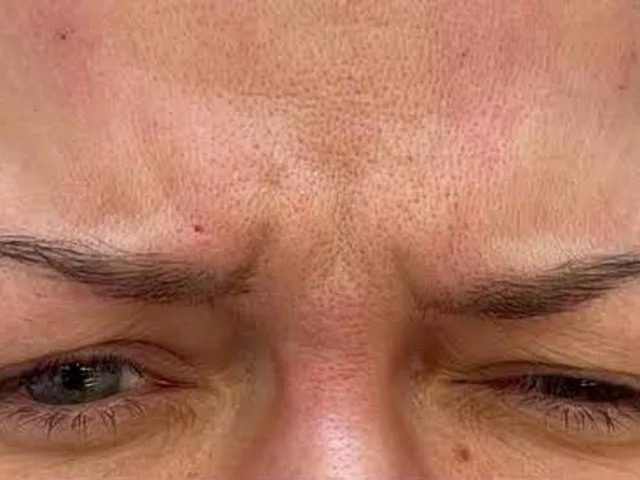 Frown lines (&ldquo;11s&rdquo;) before Botox
