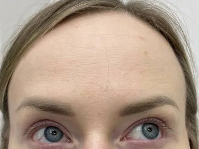 Smoother forehead lines after Botox at Pari Med Spa