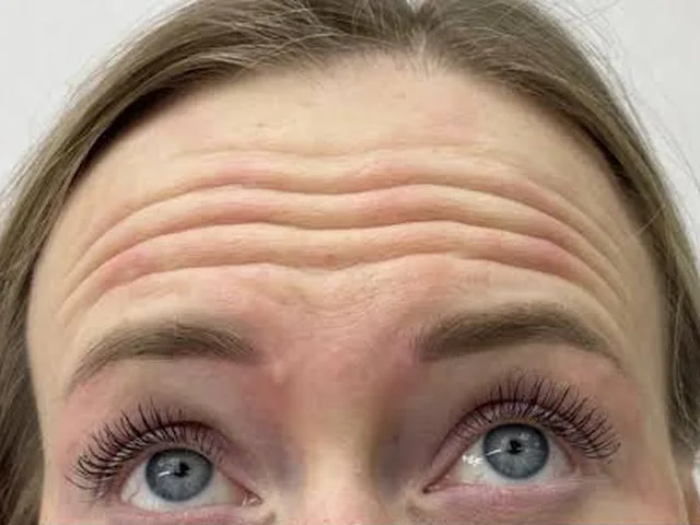 Forehead lines before Botox