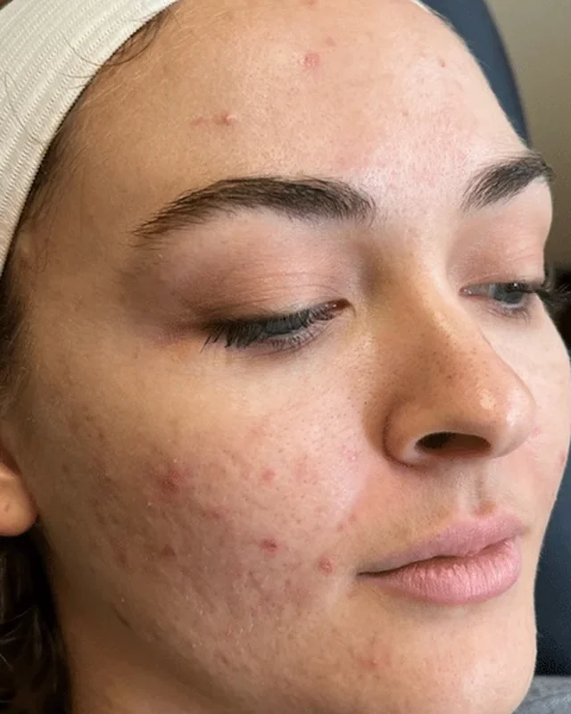 Active acne and texture on the cheek before one CoolPeel treatment