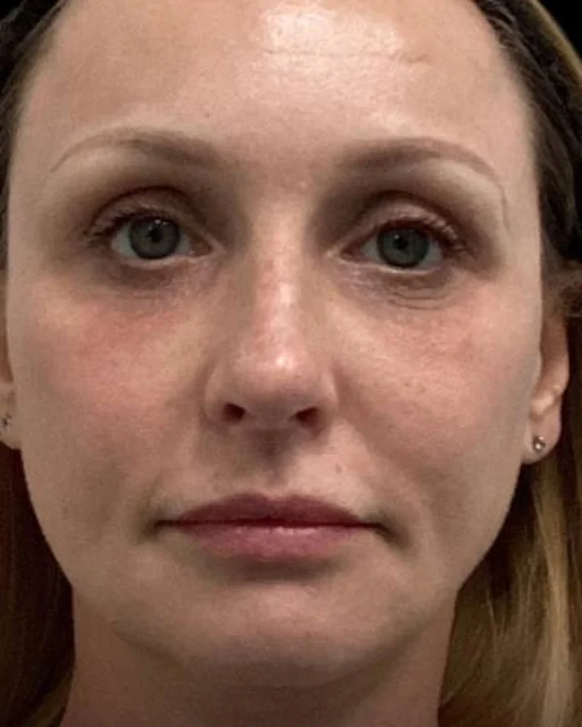 Brighter, smoother skin after CoolPeel CO2 laser at Pari Med Spa
