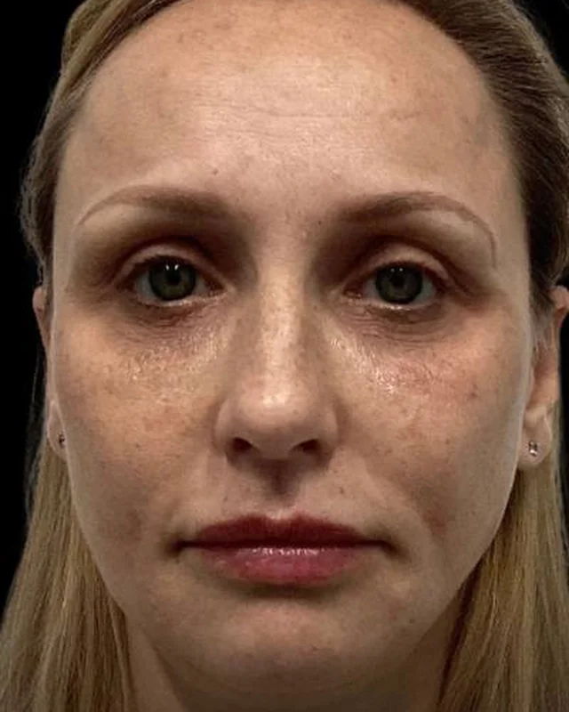 Uneven tone and fine lines before CoolPeel CO2 laser