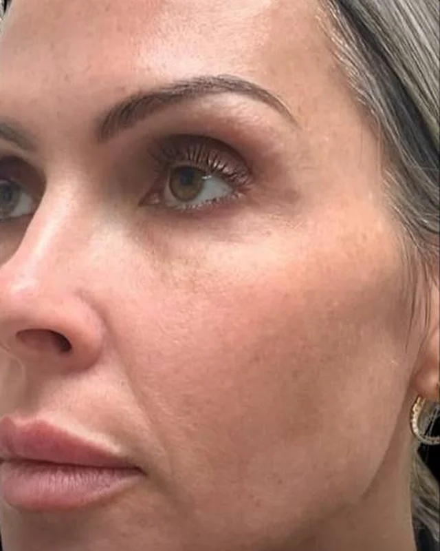 Clearer, more even skin after CoolPeel CO2 laser at Pari Med Spa