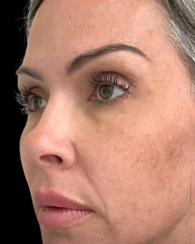 Sun spots and uneven texture on the cheek before CoolPeel CO2 laser