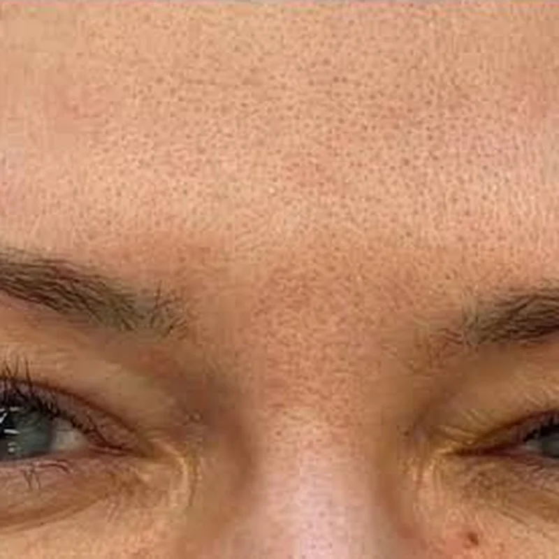 Smoother brow area after Daxxify at Pari Med Spa