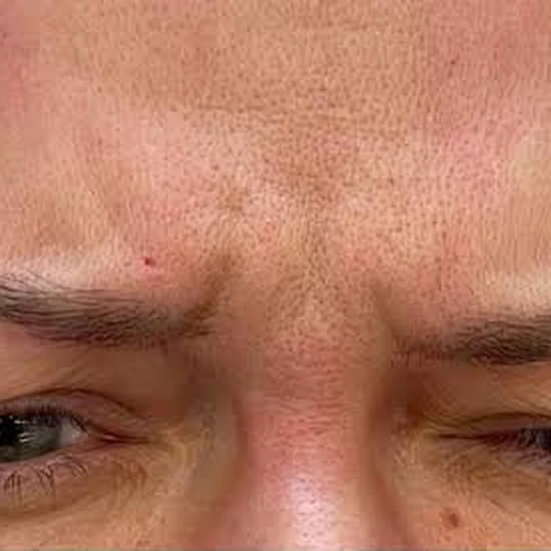 Deep frown lines between the brows before Daxxify
