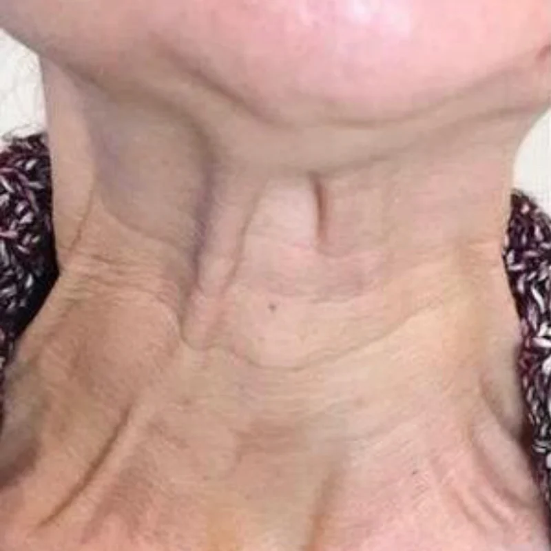Visible neck bands before Daxxify