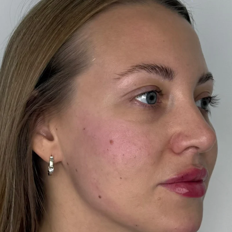 Refreshed side profile after Daxxify at Pari Med Spa
