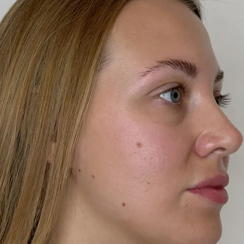 Side profile before Daxxify