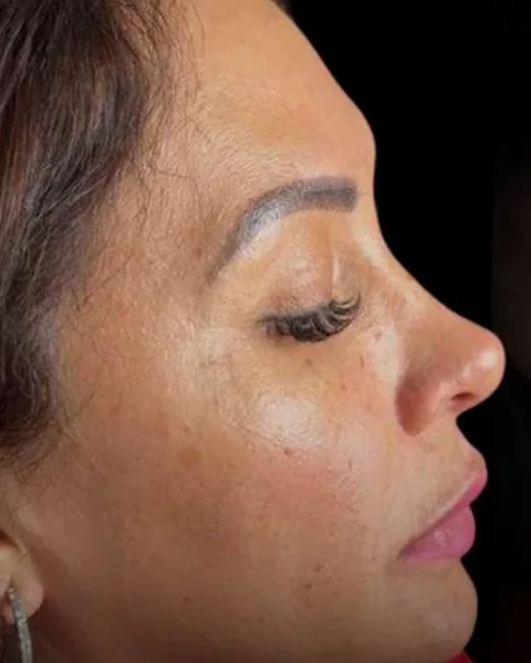Before dermal filler