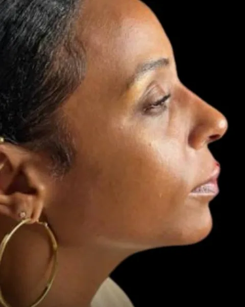 After dermal filler by Dr. Parvina