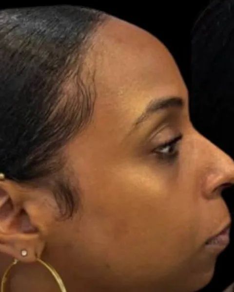 Before dermal filler