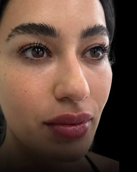 After dermal filler by Dr. Parvina