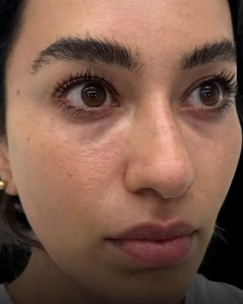 Before dermal filler