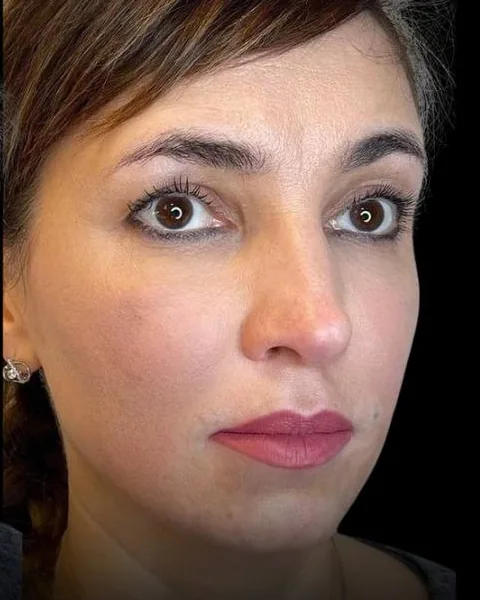 After dermal filler by Dr. Parvina