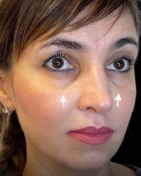 Before dermal filler