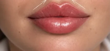 Natural-looking lip filler result