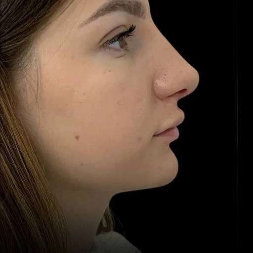 More defined chin and jawline profile after Kybella at Pari Med Spa