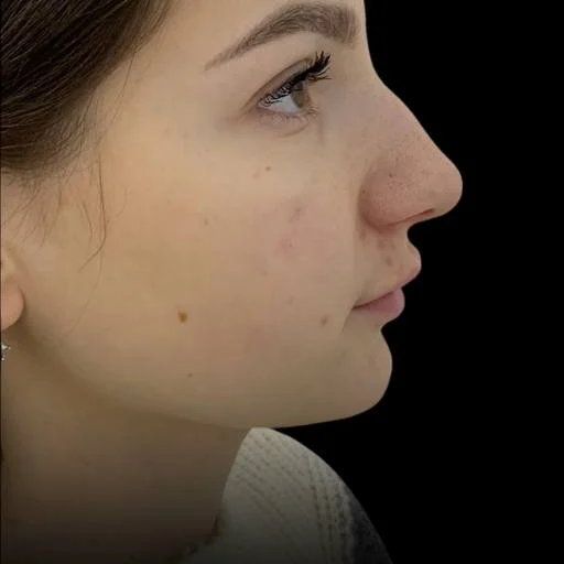 Soft chin and jawline profile before Kybella