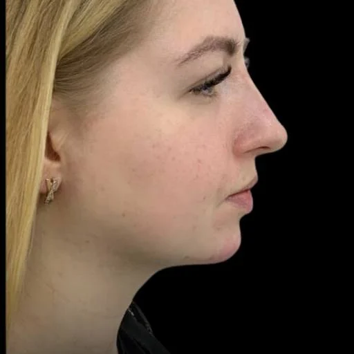 Slimmer chin and more defined jawline after Kybella at Pari Med Spa
