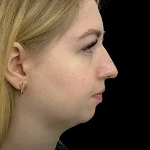 Fullness under the chin in profile before Kybella