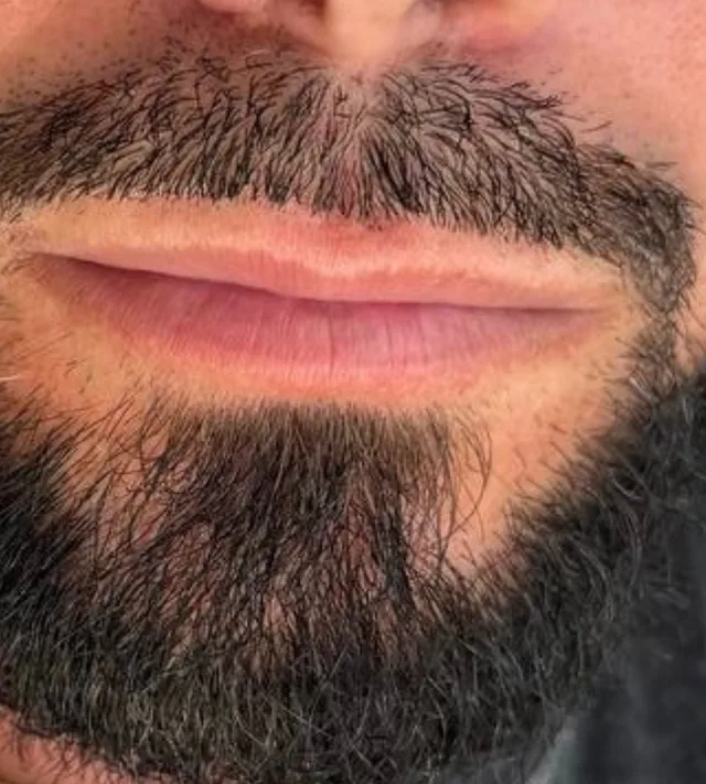 Thin lips before lip filler, male client