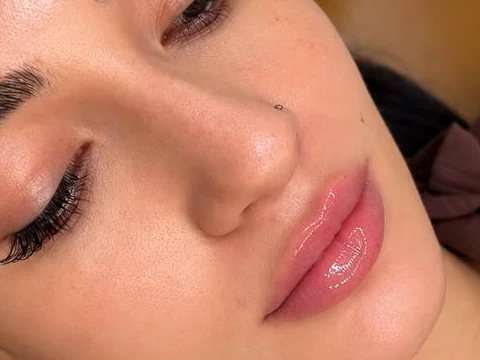 Lips after lip filler by Dr. Parvina