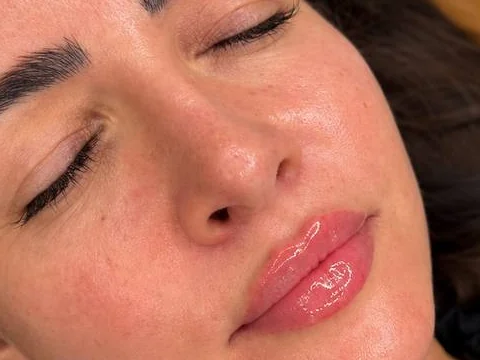 Lips after lip filler by Dr. Parvina