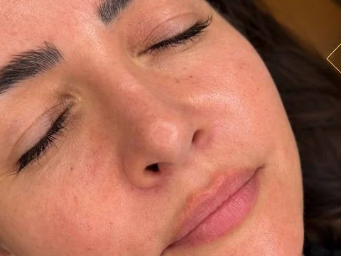 Lips before lip filler