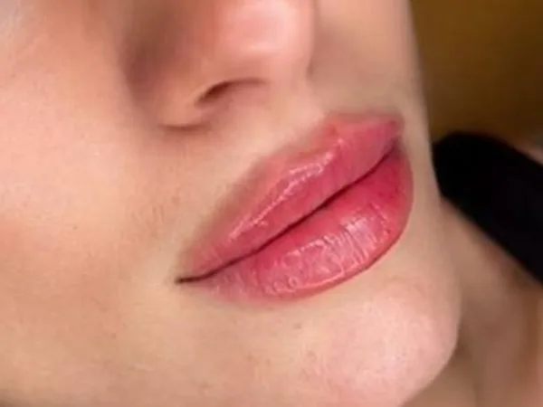 Lips after lip filler by Dr. Parvina