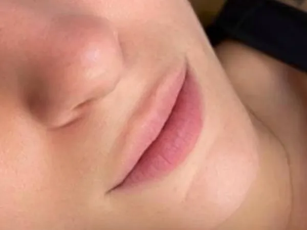 Lips before lip filler