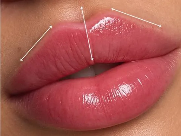Lips after lip filler by Dr. Parvina