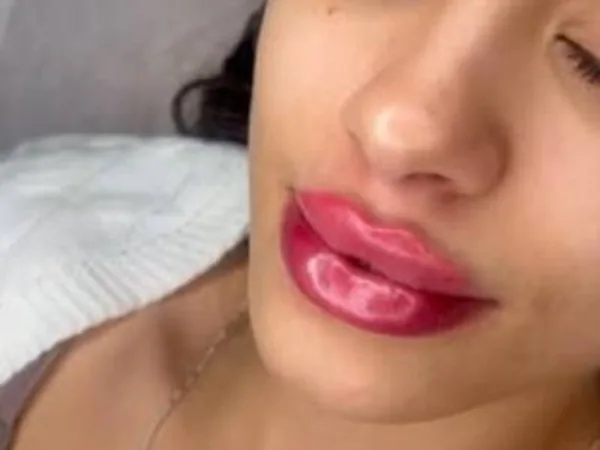Lips after lip filler by Dr. Parvina