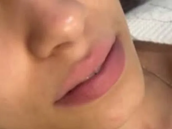 Lips before lip filler