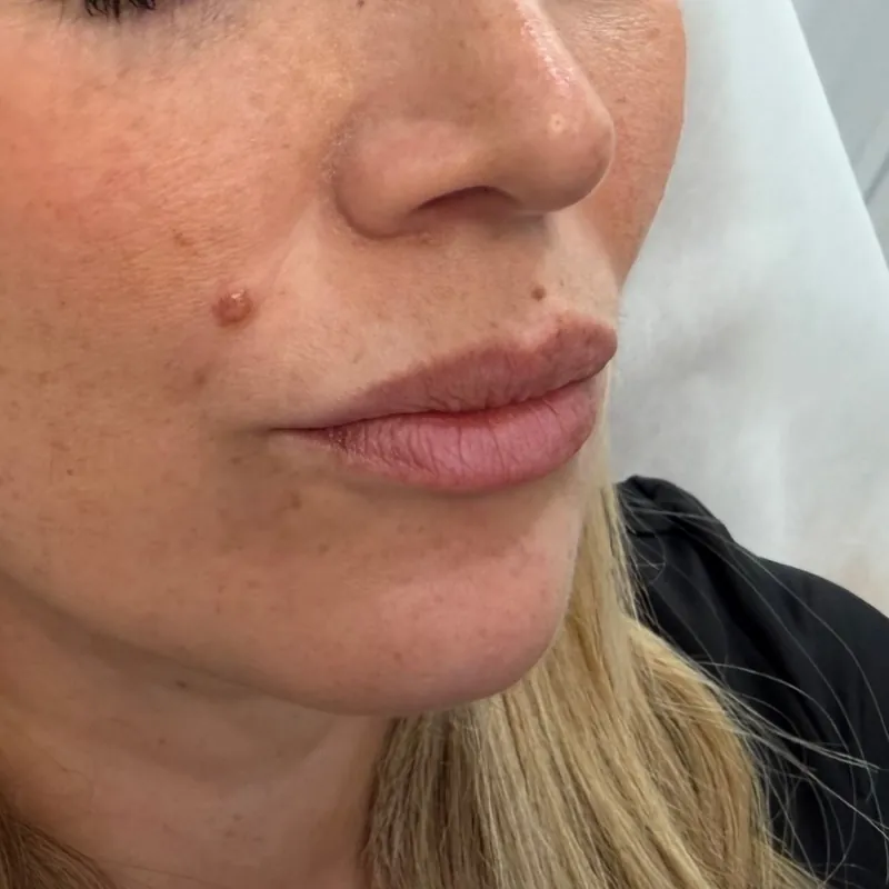 Lips before lip filler, a full, glossy pout