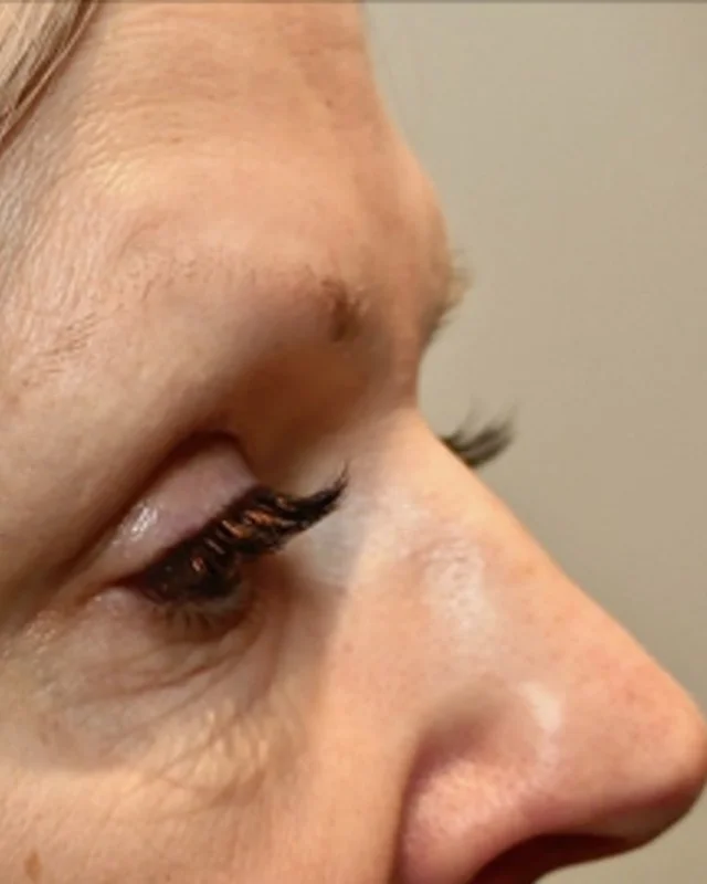 Fine lines and crepey skin around the eye before Morpheus8