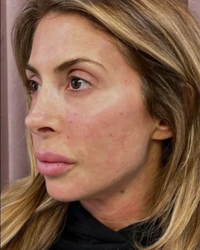 Tighter, more defined jawline after Morpheus8